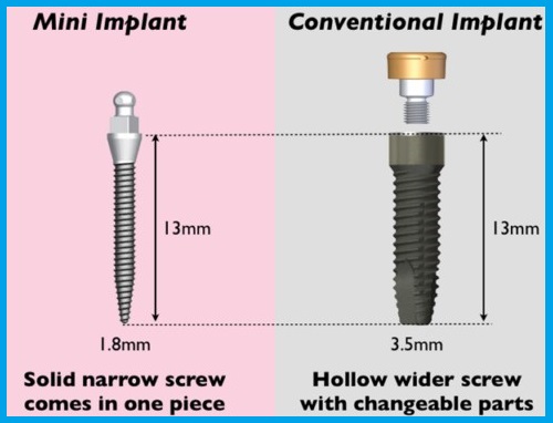 mini implant là gì?