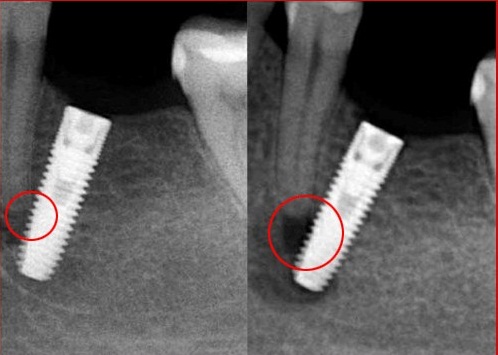 Có hay không tình trạng kích ứng sau cấy răng Implant?