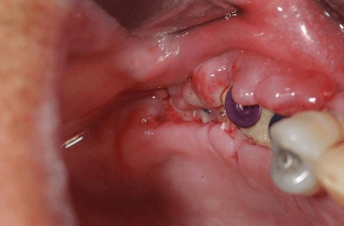 Trồng răng implant ở đâu tốt và uy tín nhất tại Hà nội?