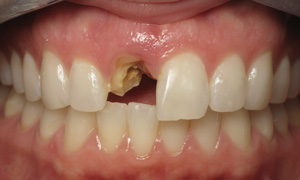 Có nên cắm implant răng cửa hay không?