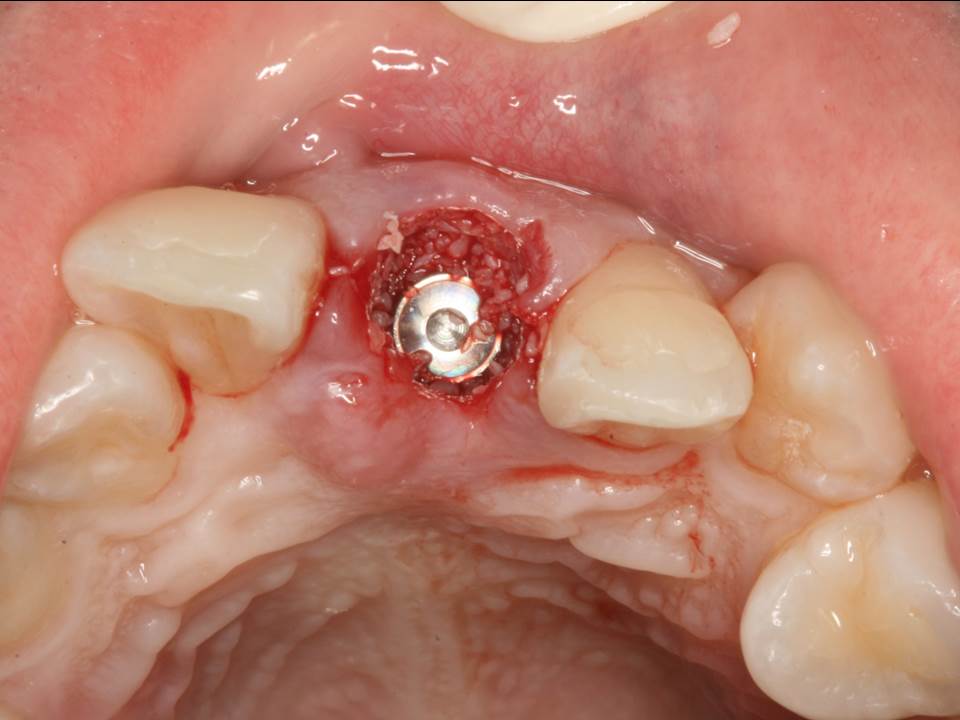 Nguyên nhân trồng răng Implant sau khi nhổ răng vẫn phải ghép xương?