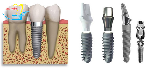 Giá làm răng implant là bao nhiêu?