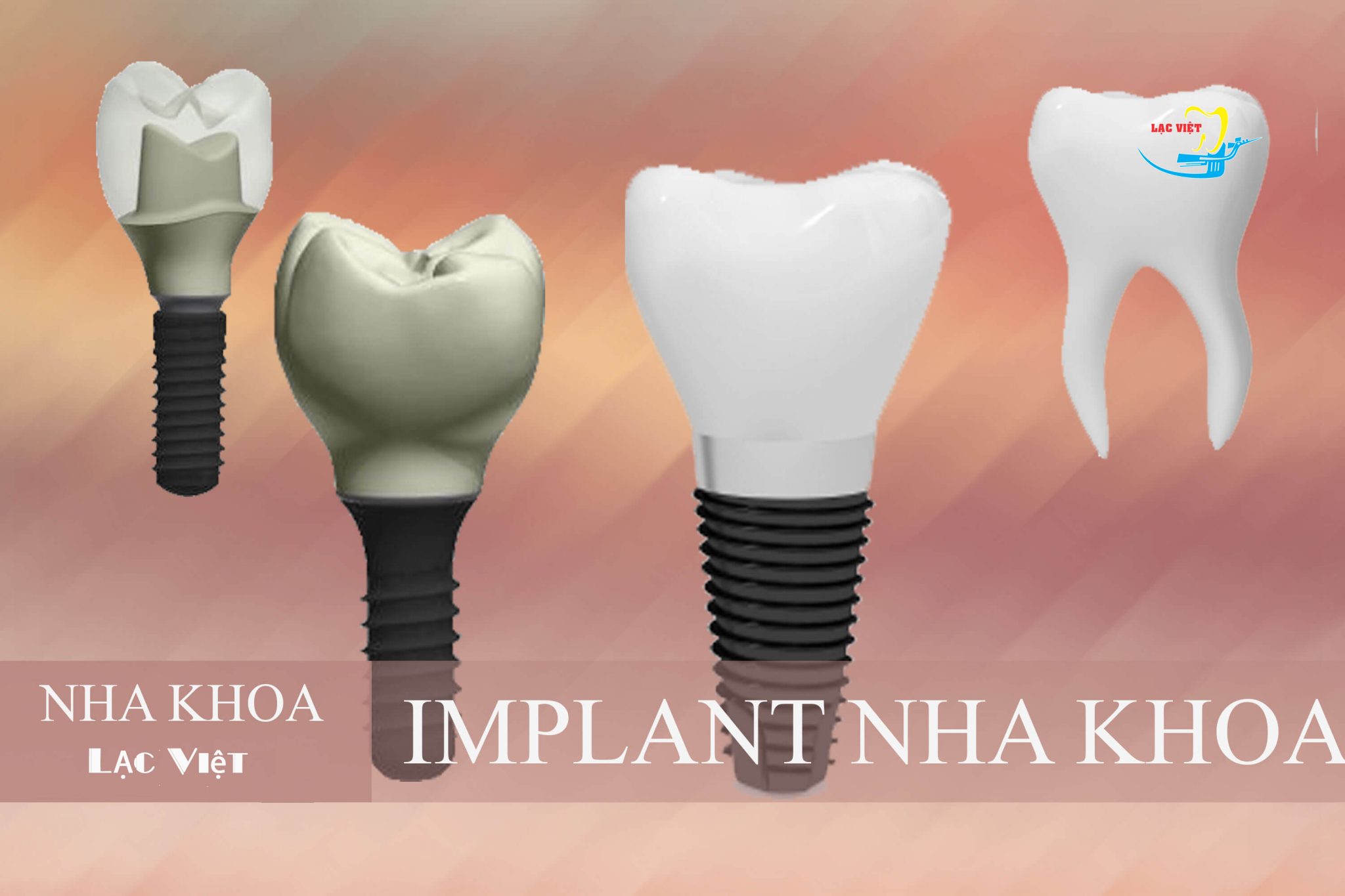 Cùng phân tích những trường hợp nào có thể ghép răng Implant nhanh nhất
