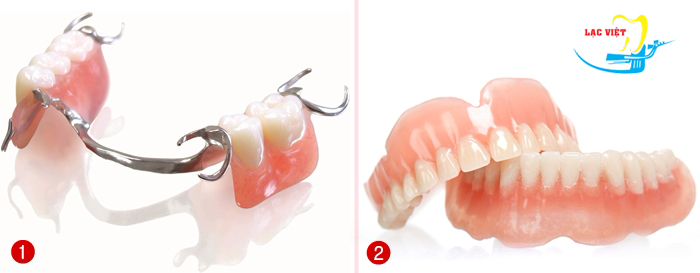 Làm răng giả mất bao lâu mới hoàn thành và có răng đẹp nhất?