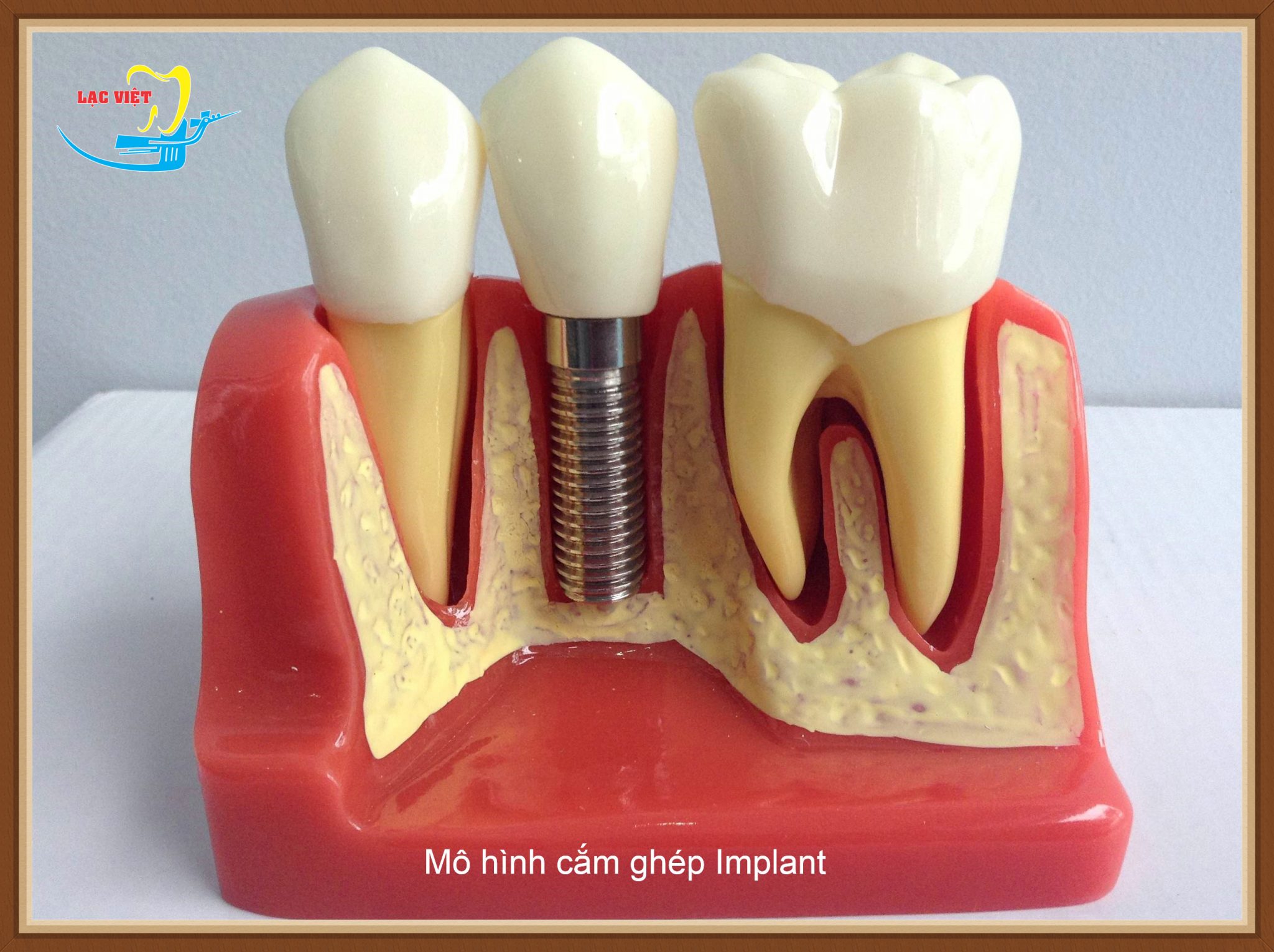 Thực hư vấn đề "Làm răng implant tại sao lại đắt"