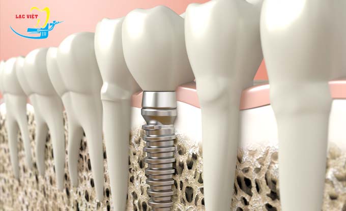 Làm sáng tỏ nghi vấn “Răng implant khỏe hơn răng thật”