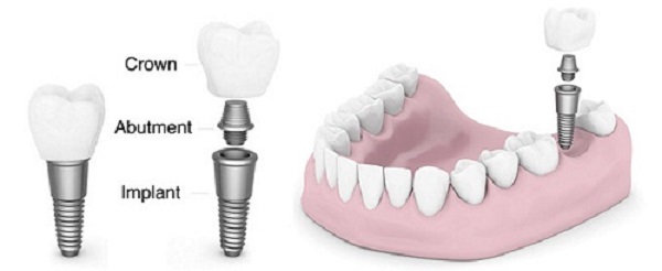 kỹ thuật trồng răng implant
