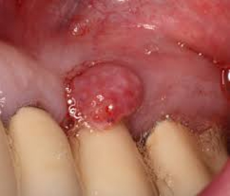răng implant bị lung lay