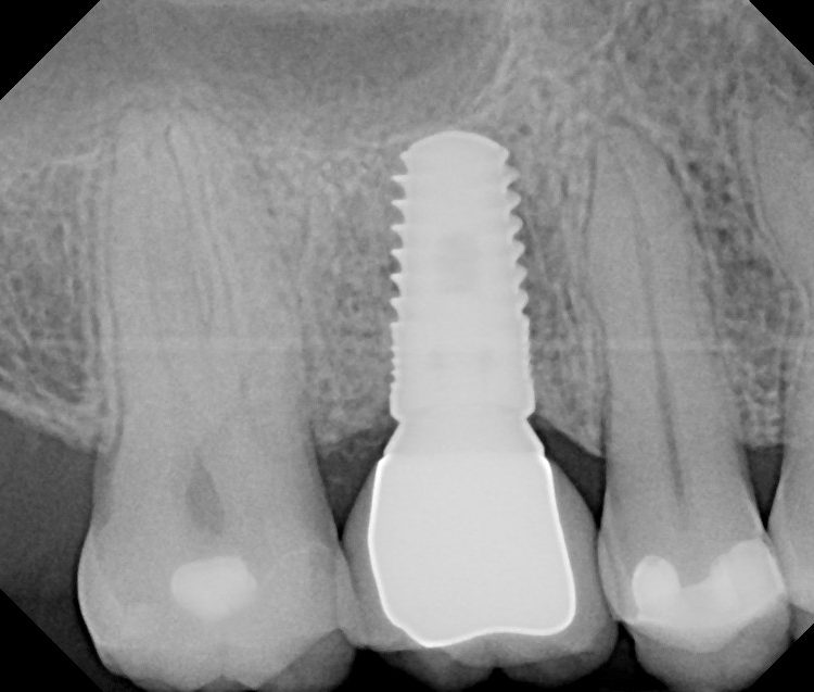 Khi nào nên trồng răng implant? Thời điểm trồng implant thích hợp nhất.