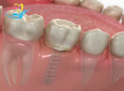 Bật mí trồng răng cấm bằng kỹ thuật cầu răng nên hay không?