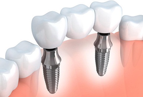 Có nên áp dụng song song 2 kỹ thuật làm Cầu răng và Implant không?