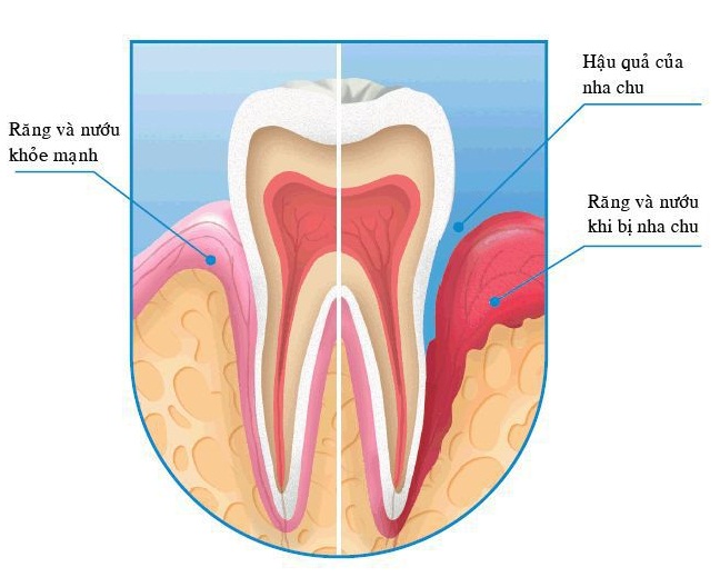 các giai đoạn viêm quanh răng