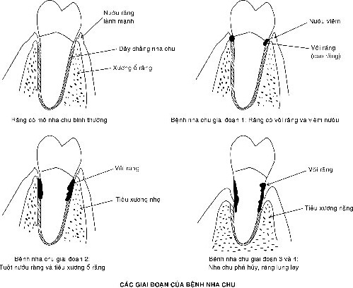 các giai đoạn viêm quanh răng