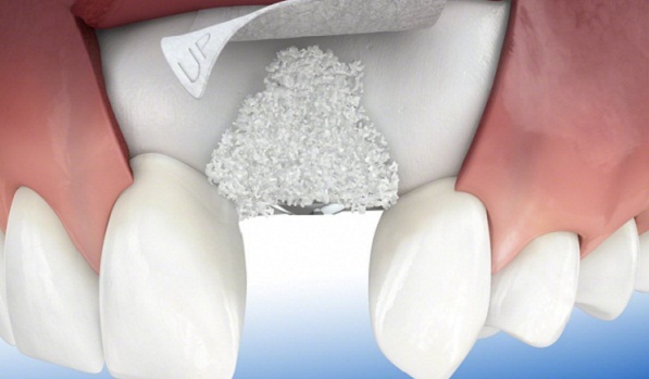 Ghép xương khi cấy răng Implant khi nào thực hiện là tốt
