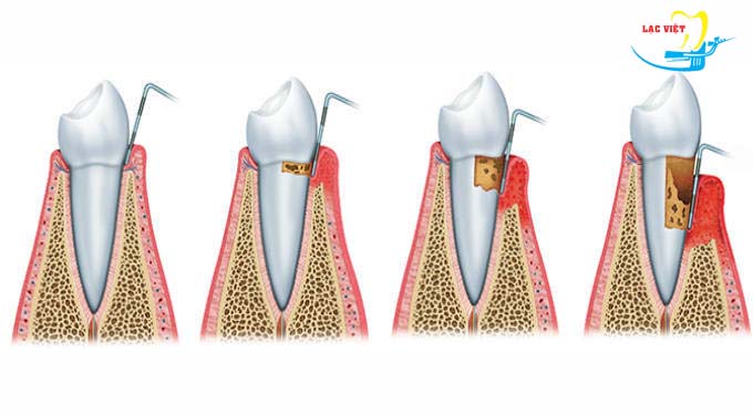 Những giai đoạn của bệnh viêm nha chu chân răng bạn nên biết