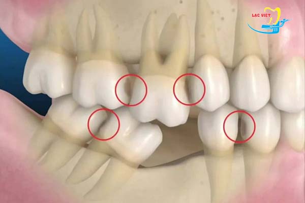 Tác hại không ngờ của việc mất răng lâu ngày và phương pháp khắc phục