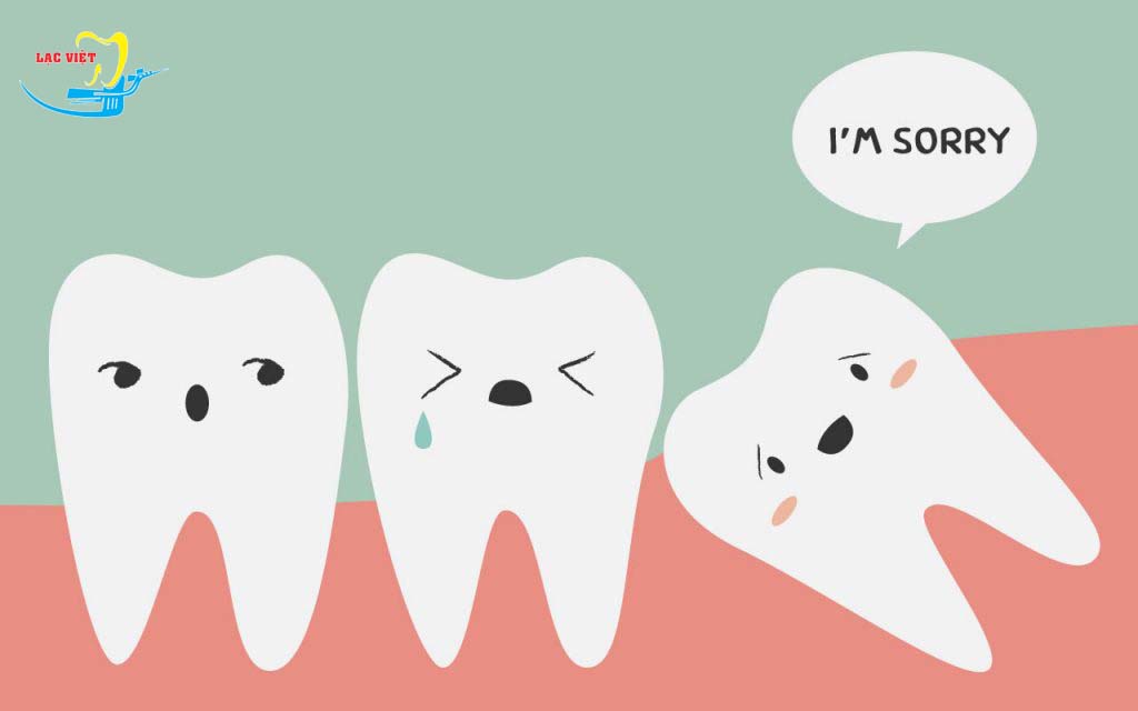 Nhổ răng khôn hàm trên có khó lắm không