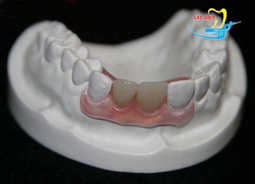 Trồng răng giả tháo lắp có thể sử dụng được trong bao lâu