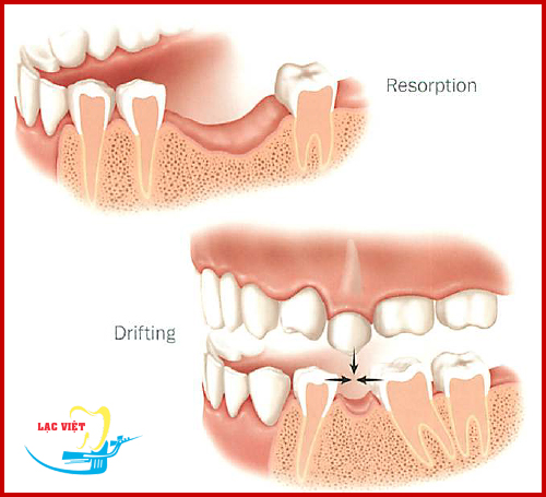 Răng bị nhổ lên sau mất răng nên làm thế nào