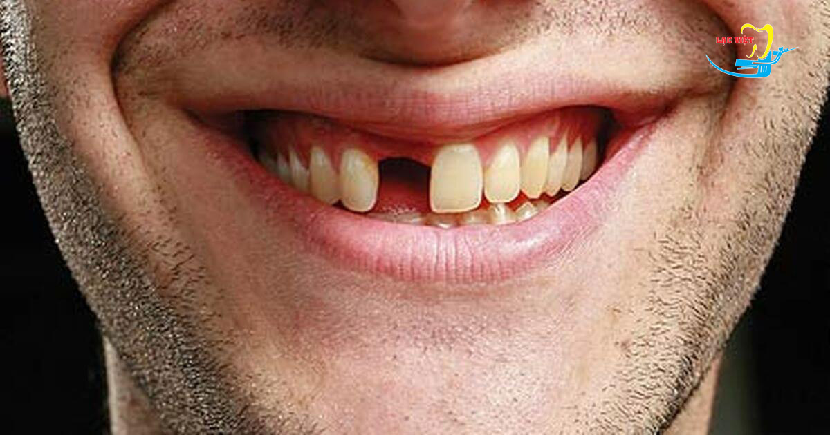 Mất 1 răng thì làm cầu răng hay trồng implant