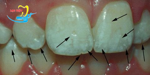 Răng có nhiều vết trắng đục có nên tẩy trắng không