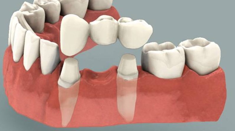 Có nên áp dụng song song 2 kỹ thuật làm Cầu răng và Implant không?