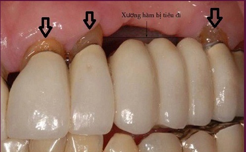 mật một răng nên làm cầu hay trồng implant.