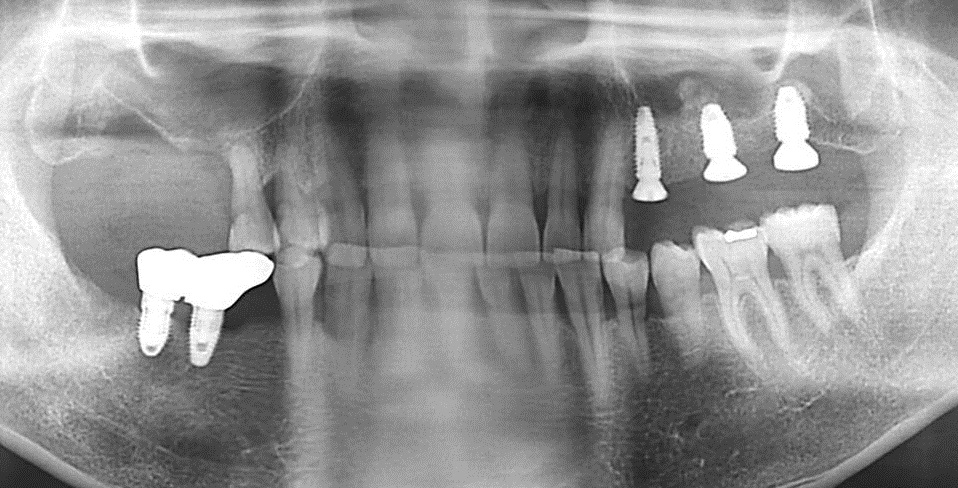 kỹ thuật trồng răng implant