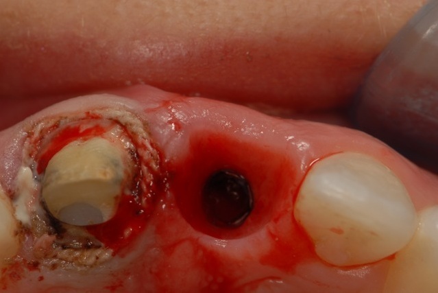 Cấy ghép implant răng cửa
