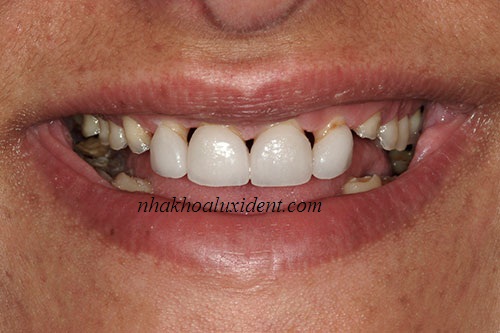 trồng răng implant cho trường hợp mất hết toàn bộ răng.