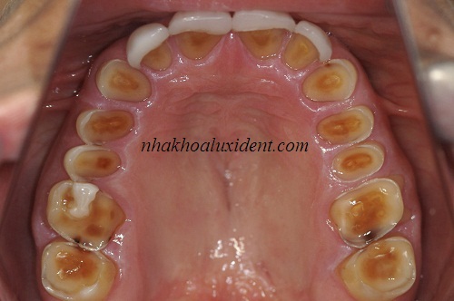 trồng răng implant cho trường hợp mất hết toàn bộ răng.