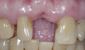 Cấy ghép implant răng cửa 11 bị gãy do tai nạn – Một trường hợp khó.