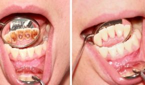 Việc lấy cao răng và tẩy trắng có thể làm một lần?