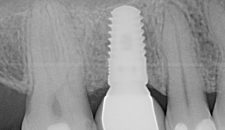 Làm răng implant giá bao nhiêu tại Hà Nội