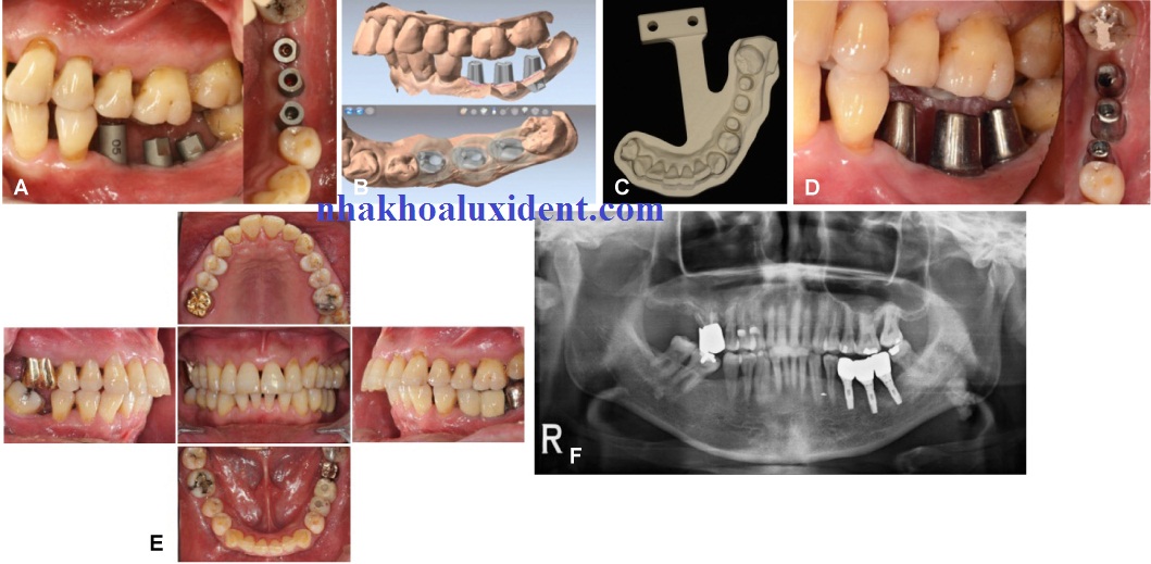 quy trình trồng răng implant.