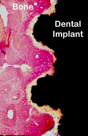 Người cắm implant có bị đau về sau không.