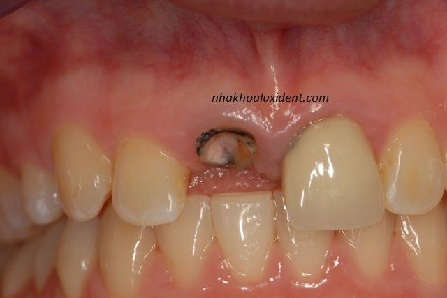 Cấy ghép implant răng cửa 11 bằng kỹ thuật vi phẫu imediad loading.